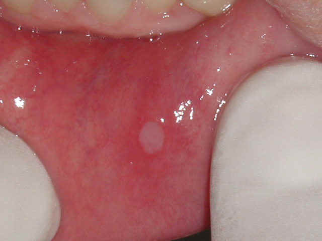 De la crema o el ungüento del hongo de los pies